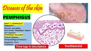 Pemphigus Vulgaris Pathogenesis clinical features oral manifestations  Pemphigus Variants PART 1 [upl. by Kappenne891]