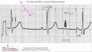 Interval Measurements 64  ECG  EKG Interpretation  BASIC [upl. by Atsirc252]