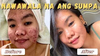 HOW EPIDUO FORTE WORKS FOR ACNE  HOW TO USE  IMPORTANT TIPS  ACNE JOURNEY [upl. by Yoong]