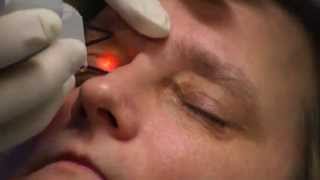 Xanthelasma laser treatment [upl. by Nort]