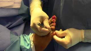 Hammer Toe 5th Digit Surgery  Dr Nagler [upl. by Akila]