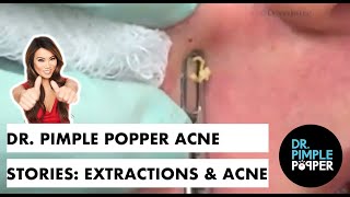 Dr Pimple Popper Acne Stories Extractions amp Acne [upl. by Cordova]