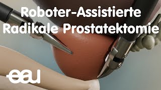 RoboterAssistierte Radikale Prostatektomie [upl. by Marie]