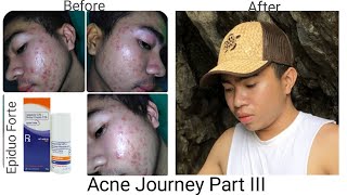 My Acne Journey Part 3  How to Apply Epiduo Forte [upl. by Natsyrt]