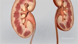 What are kidney stones  National Kidney Foundation [upl. by Ynnaej]