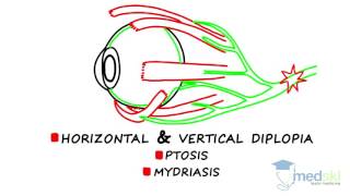 Convergence Insufficiency explained by behavioral optometrist [upl. by Arymas]