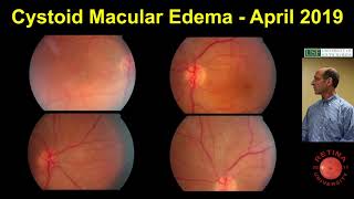 Cystoid Macular Edema [upl. by Nitsyrk660]