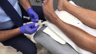 Ankle Steroid injection [upl. by Suilmann]