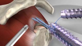 Knotless Rotator Cuff Repair with Arthrex® SpeedFix™ [upl. by Garcon]